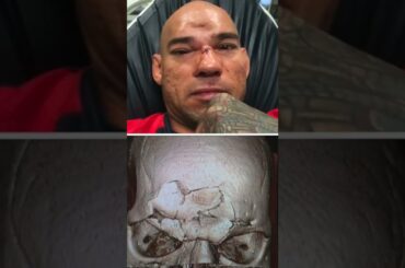 The Worst Injury in MMA History?